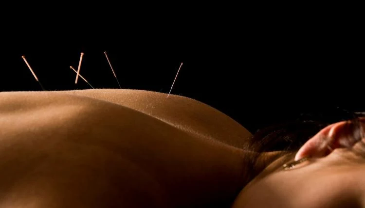 Acupuncture needles placed along a bare back — treatment detail